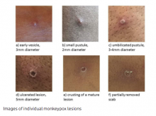 Monkeypox